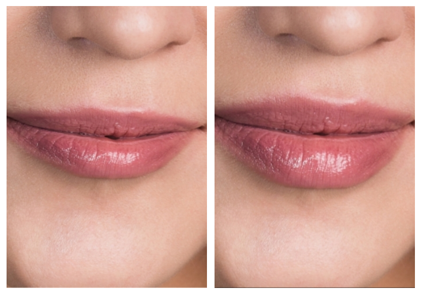Before and after of PDO thread treatment to lip area.