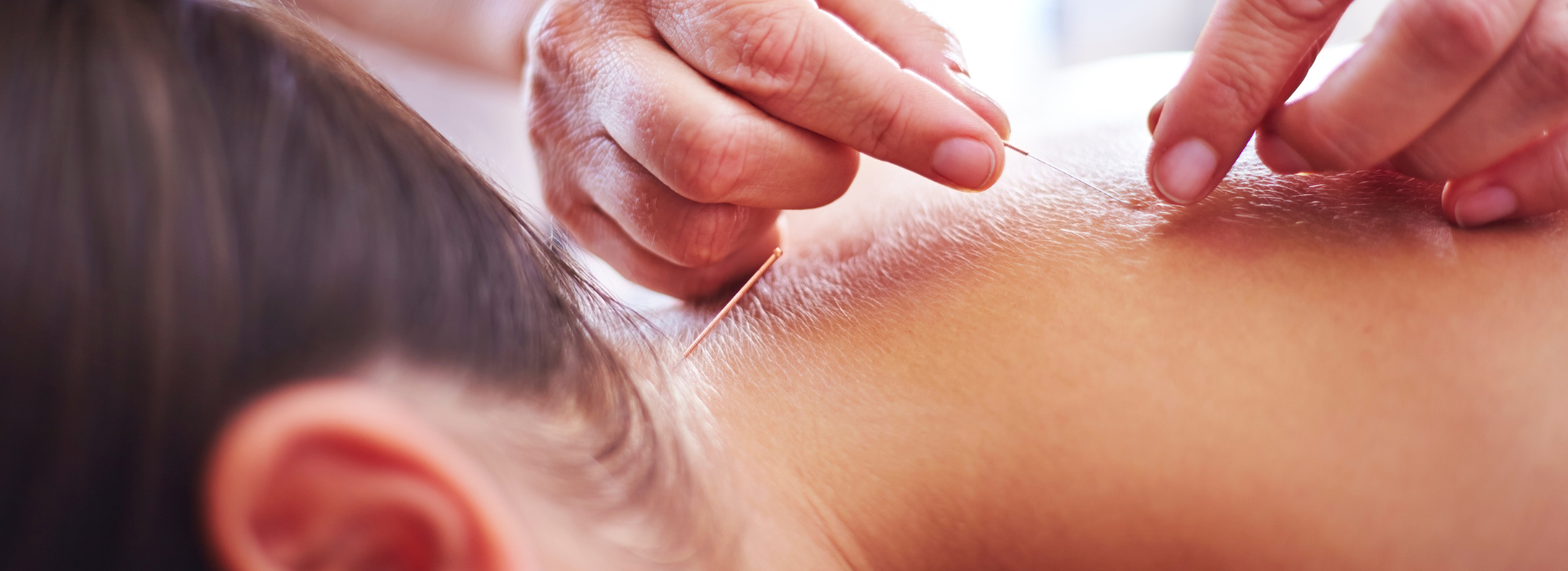 What To Expect at Your First Acupuncture Appointment(00)